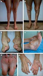 Jugendliche osteoporose , rachitis oder der glasknochenkrankheit ( osteogenesis imperfecta ) Diagnosis Natural History And Management Of Charcot Marie Tooth Disease The Lancet Neurology
