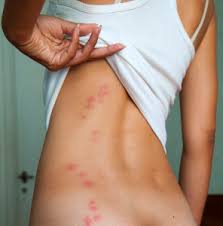 Image result for bedbug bites look like