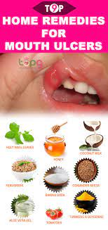 Top 9 Home Remedies For Mouth Ulcers Mouth Ulcers Ulcer Remedies Mouth Canker Sore