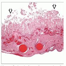 Image result for Necrotizing Enterocolitis