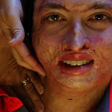 'Out of the flames of hell': Burned firefighter