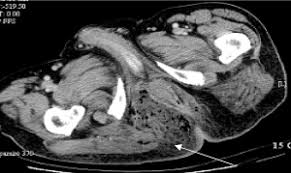 Introduce yourself to the patient including your name and role. Early Signs Of Fournier Gangrene Radiological Characteristics