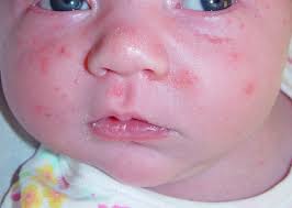 He may prescribe a topical treatment or oral antibiotics. Neonatal Acne Acne Neonatal And Infantile Dermatology Advisor