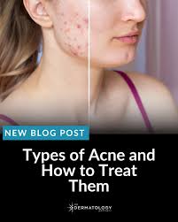 Summer's around the corner—now's the time to prep your skin! Learn what  dermatologists recommend before temps rise in this recent feature in our  bio! #summer #skincareroutine #summerskin #glowingskin #dermatology