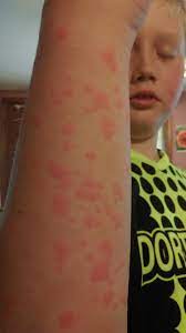 Way Ot Allergic Reaction To Azithromycin Hot Topics Forums What To Expect