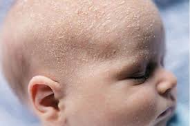 Image result for Cradle Cap