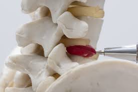 Forbidden to do any upper extremity gym. Why You Can And Should Lift Weights With A Herniated Disc Tony Gentilcore