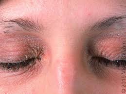 It can be triggered by allergy, irritation or viral bacteria. Eyelid Dermatitis Eczema Uptodate