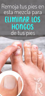 Hongos En Las Uñas De Las Manos Como Eliminarlos 3 Remedios Caseros Para Eliminar Los Hongos En Las Unas De Los Pies En 2020 Remedios Para Hongos En Los Pies Hongos En Las Unas Eliminar Hongos De Las Unas