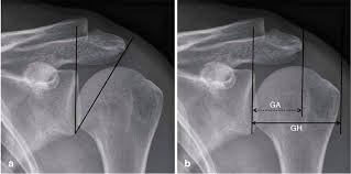 Acromion, bigliani found three , type edited by. Impingement Syndrom Schulter Ausg 13 Klinik Am Ring