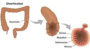 Come anticipato, la diverticolite (soprattutto quella complicata) richiede il digiuno totale e un'alimentazione di tipo parenterale associata ad antibiotici; Diverticoli Diverticilosi Alimentazione E Rimedi