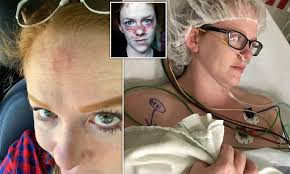 They are rarely dangerous … Woman Was Diagnosed With Skin Cancer Three Times After Initially Mistaking Her Spot For Acne Daily Mail Online