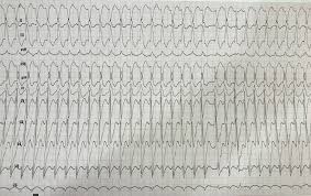 Dr Smiths Ecg Blog February 2017