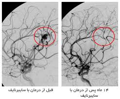 Image result for ‫قبل و بعد از درمان با سایبرنایف‬‎