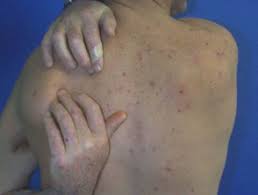 Uraemic Pruritus Dermnet Nz