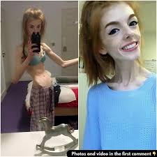 This young woman only ate one piece of bread a day for 5 years. Now grab a  tissue before you see her today