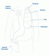 Diaphragm Pacing Explained Avery Biomedical Devices Inc
