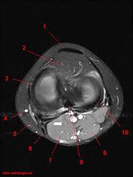 Abnormal anatomy with normal signal. Atlas Of Knee Mri Anatomy W Radiology