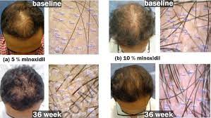 Minoxidil can also cause your hair to shed, especially when you first start. High Strength Minoxidil Does 10 And 15 Work Better Hairverse