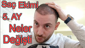 Sac Ekimi Sonrasi 5 Ay Neler Yasandi Degisimi Birlikte Gorelim Hair Transplantation Youtube