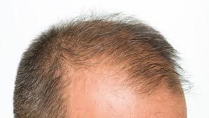 Sac Ekimi Sac Ekimi Konya Ftm Sac Ekim Merkezi