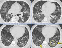 A pelvic ct scan can be used to detect several types of cancer. The Radiology Assistant Covid 19 Imaging Findings
