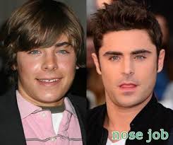 He claimed that zachary had new nose which was done with a nose. Zac Efron Plastic Surgery Through Nose Job Zac Efron Plastic Surgery Nose Job Plastic Surgery