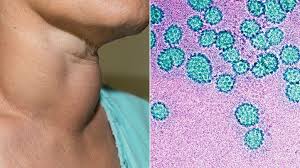Head and neck cancer can cause pain or a burning sensation when chewing and swallowing food. Basics Of Ohn Oral Head And Neck Cancer Center Everyday Health
