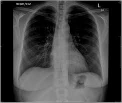 Splenic Calcification In Systemic Lupus Erythematosus Bmj Case Reports