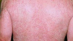 Red Man Syndrome Symptoms Treatment Picture And More