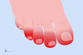 Covid 19 Skin Symptoms Covid Toes Rashes And More