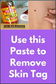 How To Remove Skin Tag In 1 Night In 2021 Skin Tag Removal Remove Skin Tags Naturally Skin Tag