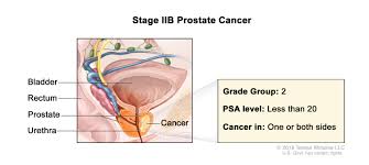 Prostate Cancer Treatment Pdq Health Professional Version National Cancer Institute