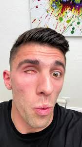 My prosthetic eye being made 😮 #fyp