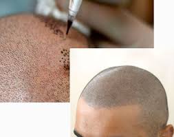 In sostanza con questa tecnica si . Tricopigmentazione Il Tatuaggio Reversibile Che Simula I Capelli