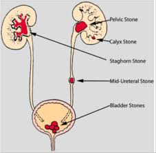 Image result for Nephrolithiasis
