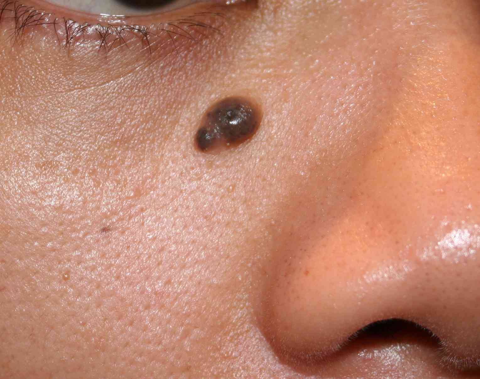 MOLE REMOVAL product image