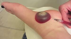 See more ideas about beetlejuice, tim burton, beetlejuice cartoon. Big Wart Blister After Freezing With Liquid Nitrogen Video Dailymotion
