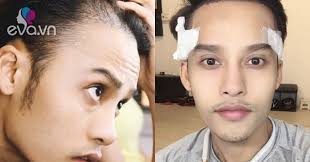 Bí quyết giúp chàng trai trẻ vượt qua mặc cảm rụng tóc, hói đầu