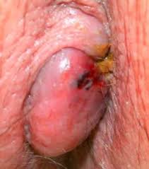 Internal hemorrhoids à¤¸à¤¾à¤ à¥? à¤?à¤®à¥?à¤? à¤ªà¤°à¤¿à¤£à¤¾à¤®