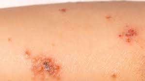 Image result for Impetigo