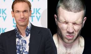 Orlistat is a medication used to help people lose weight. Embarrassing Bodies Dr Christian Jessen S Most Memorable Story Action Man Stuck Up Bum Express Co Uk