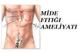mide fitigi nedir belirtileri tedavisi ve ameliyati saglik haberleri saglik doktorlar kadin