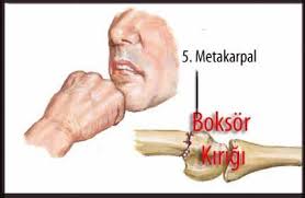 El Bilegi Kiriklari Distal Radius Ulna Kiriklari Fizyoo Fizyoterapi Elsa