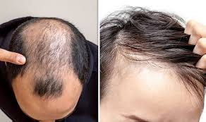 For optimal hair growth, avoid using harsh hair care products that irritate the scalp and dry out your hair. Hair Loss Treatment What Can You Do About A Receding Hairline Express Co Uk