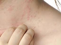 Image result for dermatitis contacta
