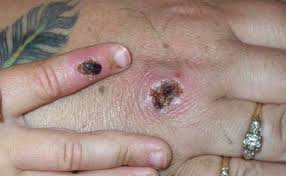 Raccomanda comunque la somministrazione del vaccino. Vaiolo Delle Scimmie Altro Che Covid Terrore Per I Primi Casi In Europa Ecco Come Ti Ammazza Libero Quotidiano