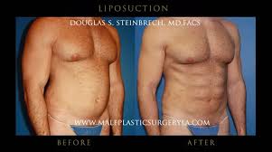 Image result for Liposuction