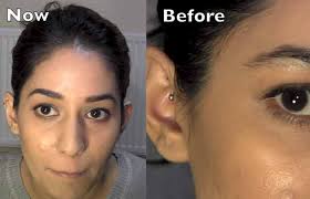 If this occurs, however, the sutures can simply be removed and the patient's face will return to its prior state. How To Thread Eyebrows A Step By Step Tutorial