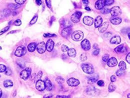Ten symptoms of thyroid cancer 1. Thyroid Cancer Wikipedia